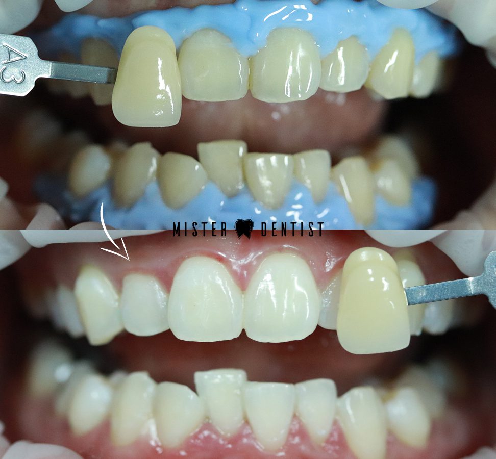 ฟอกสีฟัน - Mister Dentist Dental Clinic