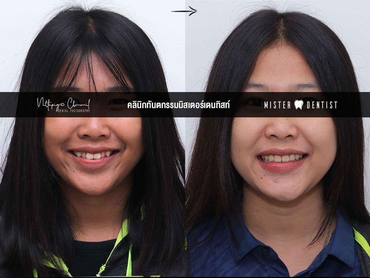 ฟันซ้อนเก