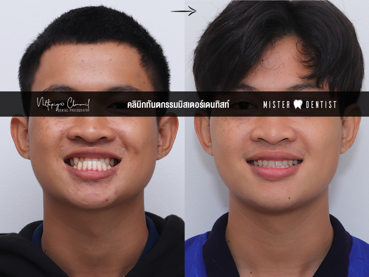 ฟันล่างคร่อมฟันบน