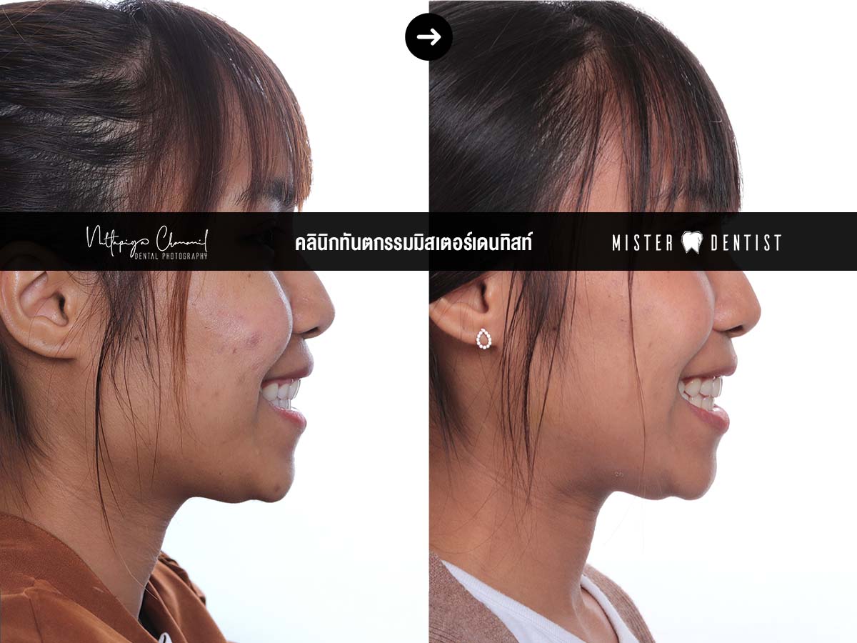 ฟันงุ้ม